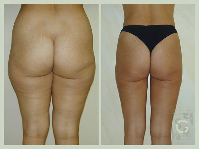 liposuccion hanche fesses jambes et cuisses