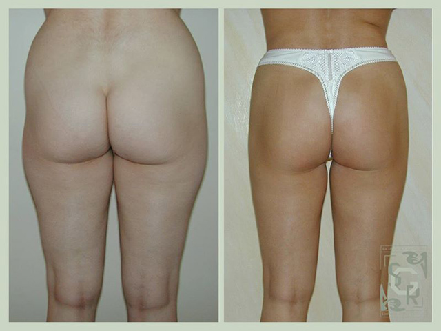 liposuccion des hanches et des fesses
