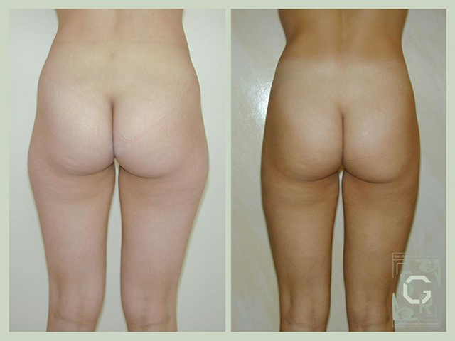 liposuccion jambes et cuisses Lyon