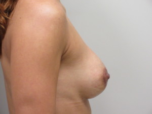 Après lipomodelage pour malformation des seins - de côté