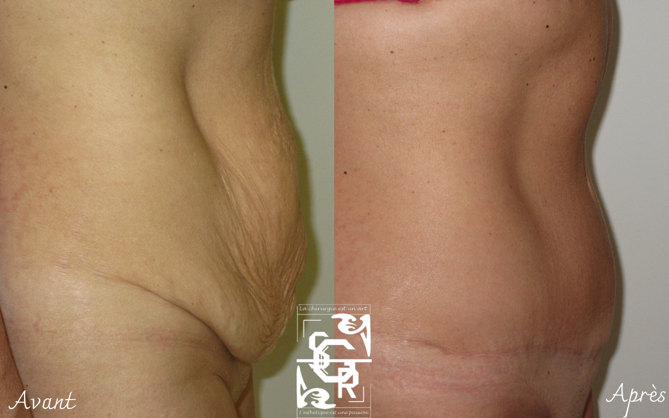 abdominoplastie vue de profil lyon