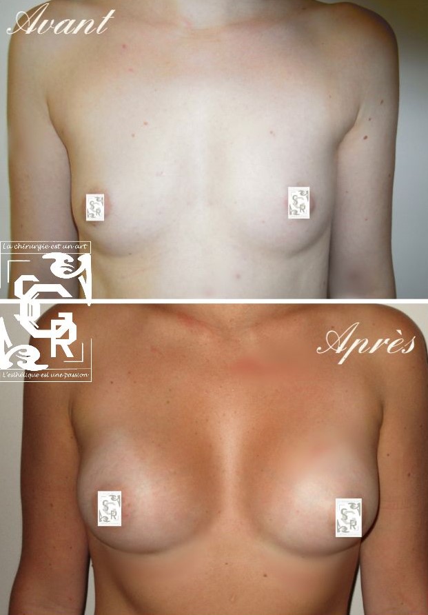 prothèses mammaires avant après