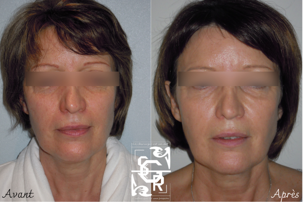 lipostructure du visage lyon