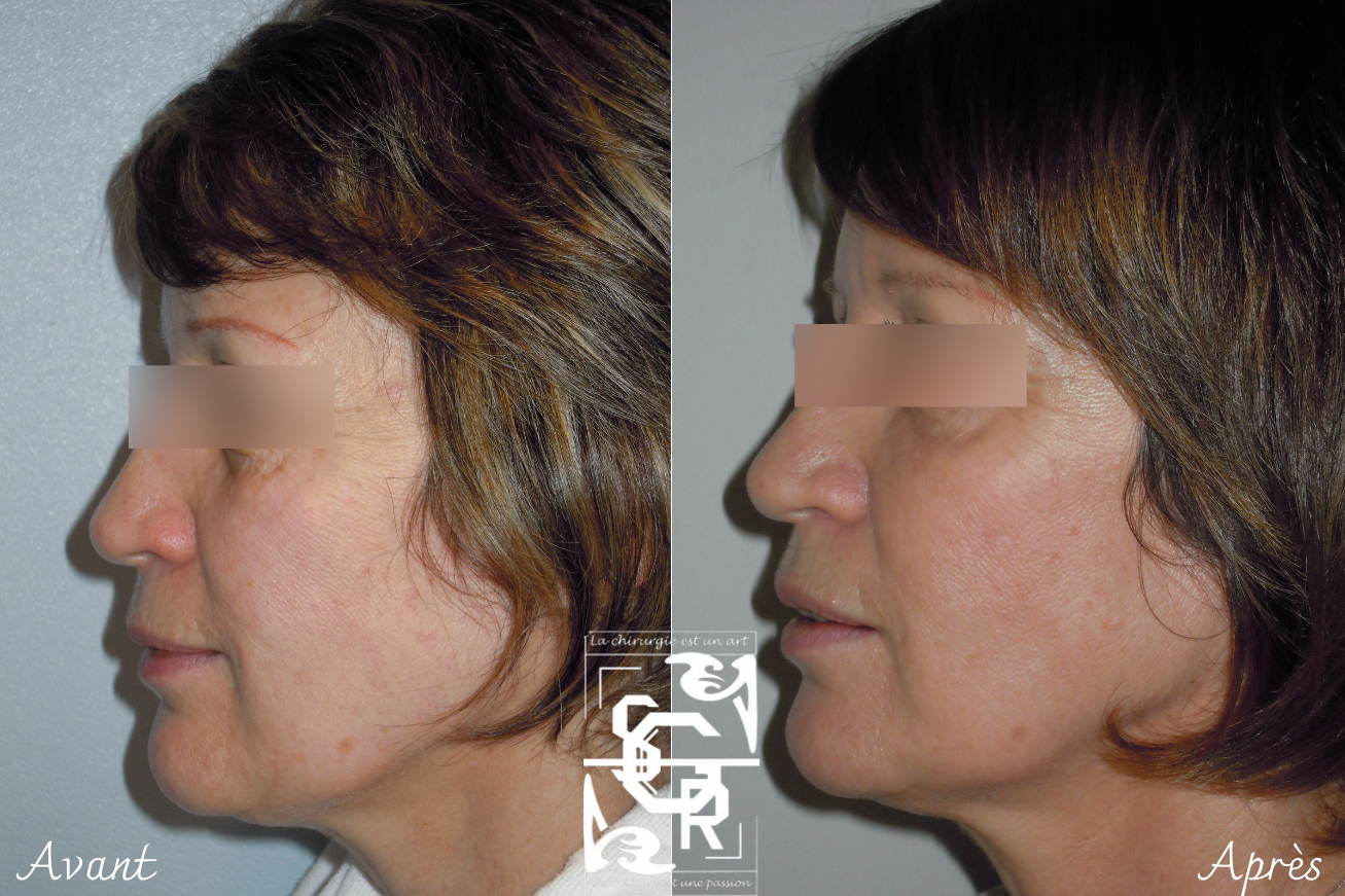 lipostructure du visage femme 60 ans