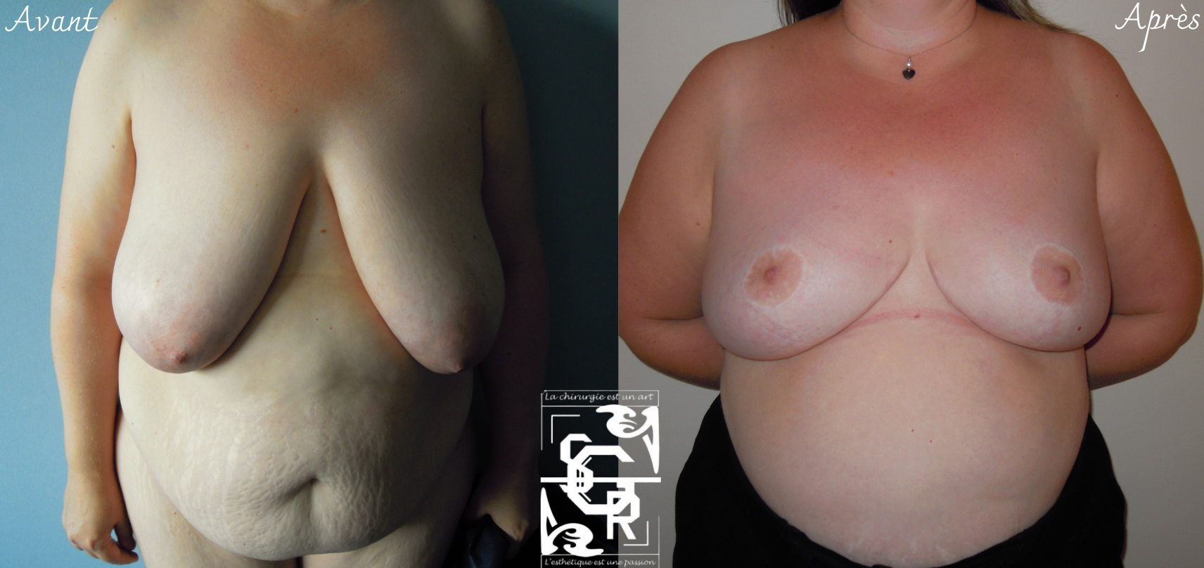 réduction mammaire spectaculaire lyon